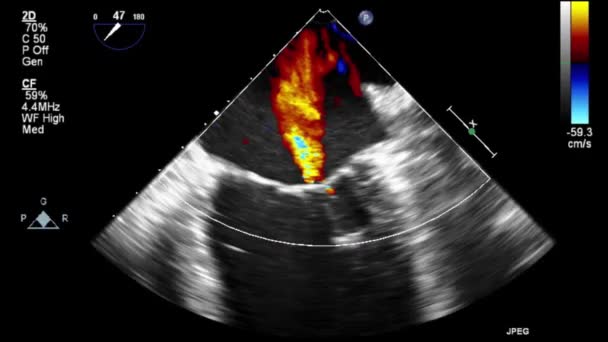 Transesophageal Ultrasound Video Doppler Mode — Stok video