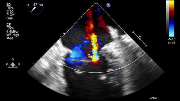 Vídeo Ultra Sonográfico Transesofágico Modo Doppler — Vídeo de Stock