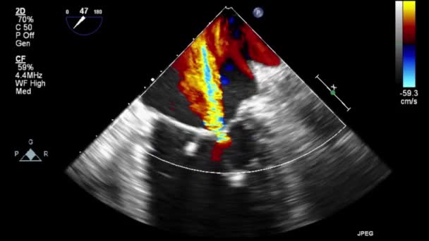 Vídeo Ultra Sonográfico Transesofágico Modo Doppler — Vídeo de Stock