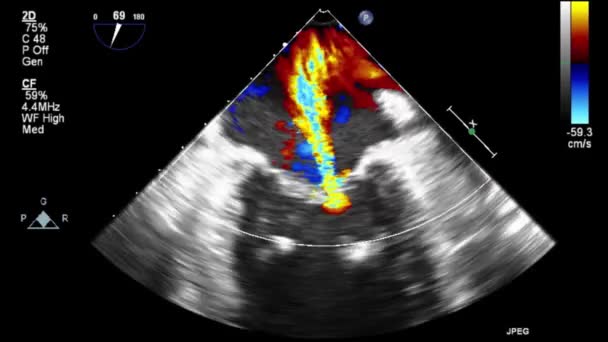 Transesophageal Ultrasound Video Doppler Mode — Stock Video