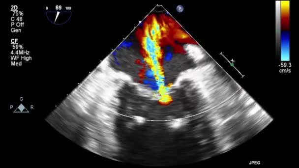 Transesophageal Ultrasound Video Doppler Mode — Stok video