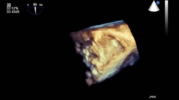 Transesophageal Ultrazvukové Video Režimu — Stock video