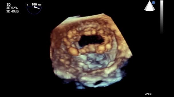 Transesophageal Ultrasound Video Mode — Stok video
