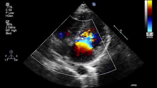 Transesophageal Ultrasound Video Doppler Mode — Stock Video