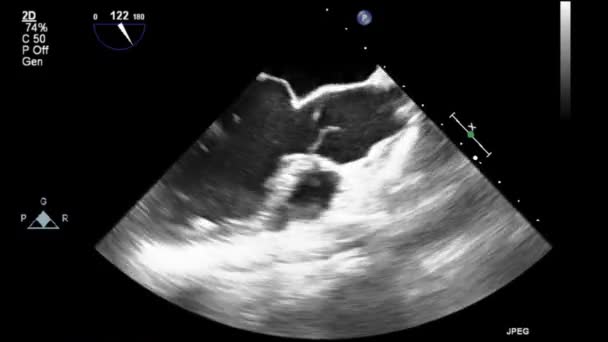 Transesophageal Ultrasound Video Gray Scale Mode — Stock Video