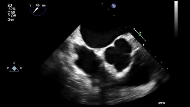 Transesophageal Ultrasound Video Gray Scale Mode — Stock Video