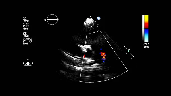 Зображення Серця Під Час Ультразвуку Доплерівським Режимом — стокове фото