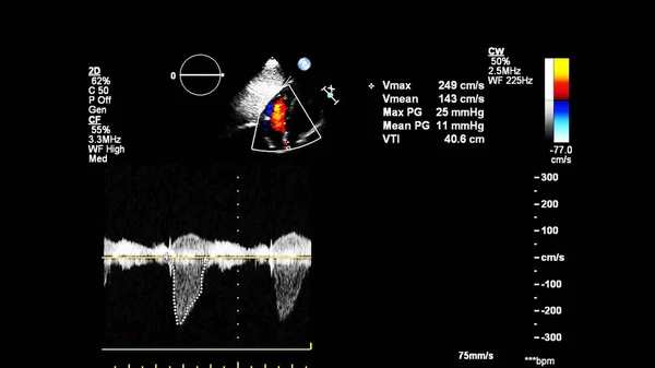 Изображение Сердца Время Трансофагеального Ультразвука Доплеровским Режимом — стоковое фото