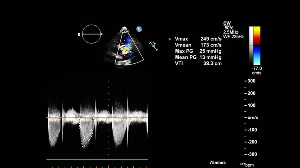 ドップラーモードで経食道超音波中の心臓の画像 — ストック写真