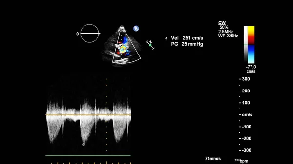 Изображение Сердца Время Трансофагеального Ультразвука Доплеровским Режимом — стоковое фото