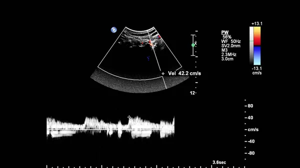 Exame Ultrassonográfico Doppler Onda Pulso Vasos — Fotografia de Stock