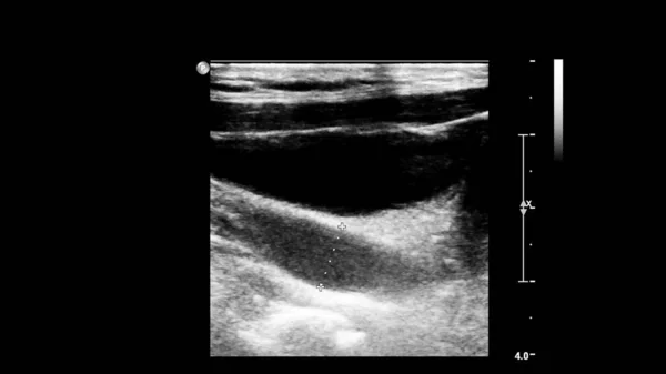 Exame Ultrassonográfico Dos Vasos Sanguíneos Escala Cinza — Fotografia de Stock