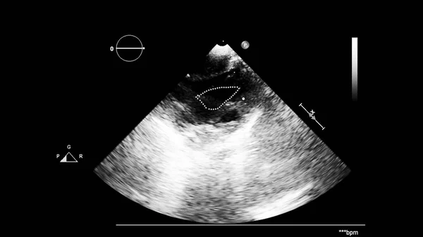 Afbeelding Van Het Hart Grijs Schaal Modus Tijdens Transesofageale Echografie — Stockfoto