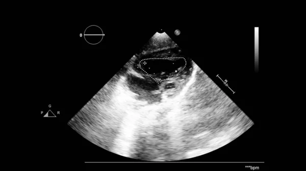经食管超声下灰度型心脏影像学 — 图库照片