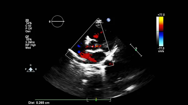 Beeld Van Het Hart Tijdens Transesofageale Echografie Met Doppler Modus — Stockfoto