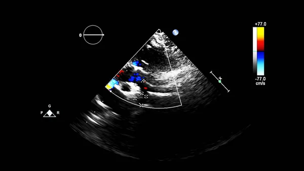 Bild Des Herzens Beim Transesophagealen Ultraschall Mit Doppler Modus — Stockfoto