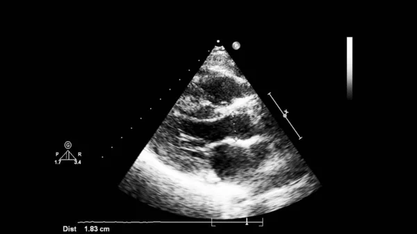 Transesofageal Ultrason Sırasında Kalbin Gri Ölçekli Görüntüsü — Stok fotoğraf