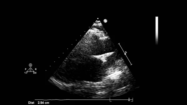 Transesofageal Ultrason Sırasında Kalbin Gri Ölçekli Görüntüsü — Stok fotoğraf