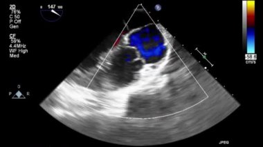 Transesophageal ultrasound video in Doppler mode.