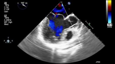 Transesophageal ultrasound video in Doppler mode.
