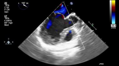 Transesophageal ultrasound video in Doppler mode.