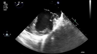 Transesophageal ultrasound video in gray-scale mode.