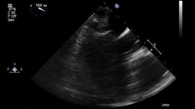 Transesophageal ultrasound video in gray-scale mode.