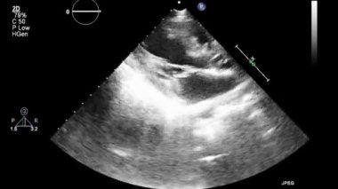 Transesophageal ultrasound video in gray-scale mode.