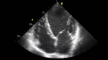 Transesophageal ultrasound video in gray-scale mode.