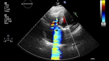 Transesophageal ultrasound video in Doppler mode.