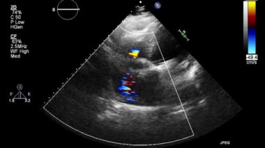 Transesophageal ultrasound video in Doppler mode.