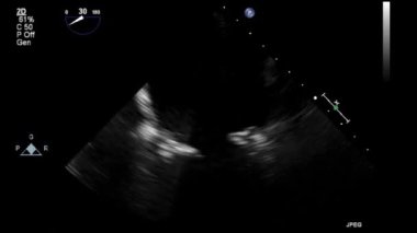 Transesophageal ultrasound video in gray-scale mode.