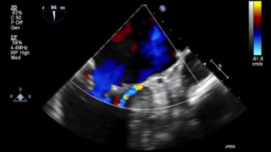 Transesophageal ultrasound video in Doppler mode.