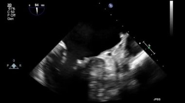 Transesophageal ultrasound video in gray-scale mode.