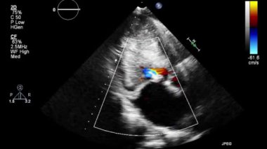 Transesophageal ultrasound video in Doppler mode.