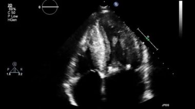 Transesophageal ultrasound video in gray-scale mode.
