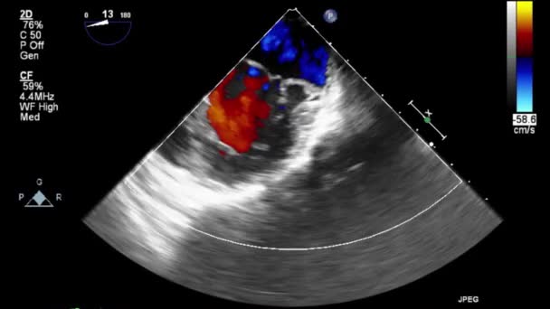 Vídeo Ultrasonido Transesofágico Modo Doppler — Vídeos de Stock