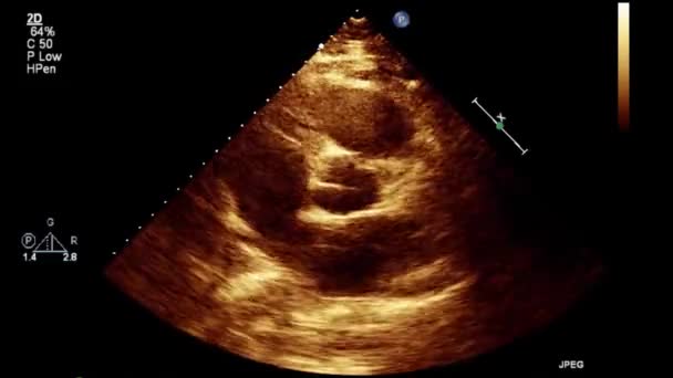 Transesophageal Ultrasound Video Gray Scale Mode — 비디오