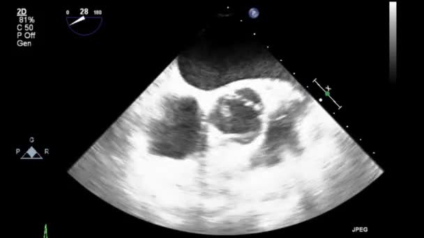 Transesophageal Ultrasound Video Gray Scale Mode — Stockvideo
