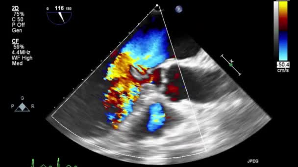 Video Ecografia Transesofagea Modalità Doppler — Video Stock