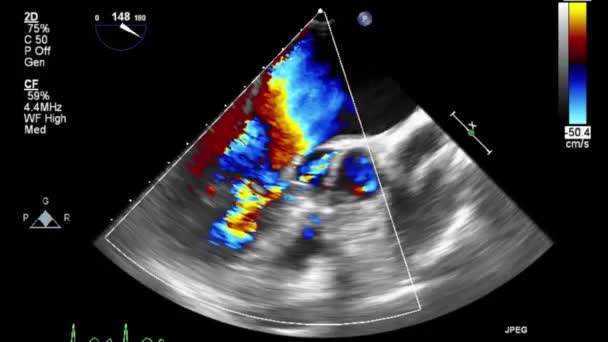 Transesophageal Ultrasound Video Doppler Mode — Stock Video