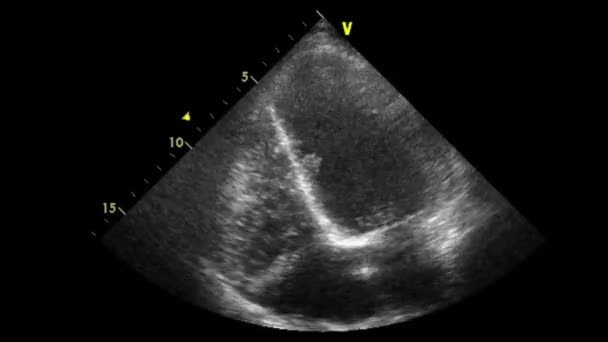 Vídeo Ultra Sonográfico Transesofágico Escala Cinza — Vídeo de Stock