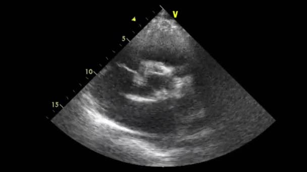 Transesophageal Ultrasound Video Gray Scale Mode — Stockvideo