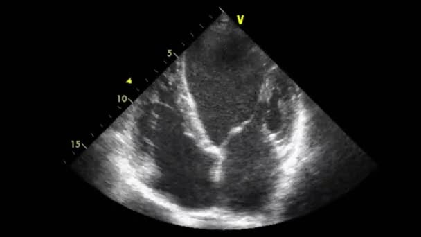 Vídeo Ultra Sonográfico Transesofágico Escala Cinza — Vídeo de Stock