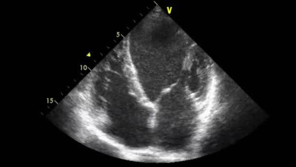 Vídeo Ultra Sonográfico Transesofágico Escala Cinza — Vídeo de Stock