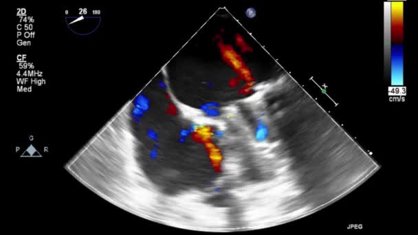 Transesophagealis Ultrahang Videó Doppler Módban — Stock videók