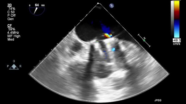 Vídeo Ultra Sonográfico Transesofágico Modo Doppler — Vídeo de Stock