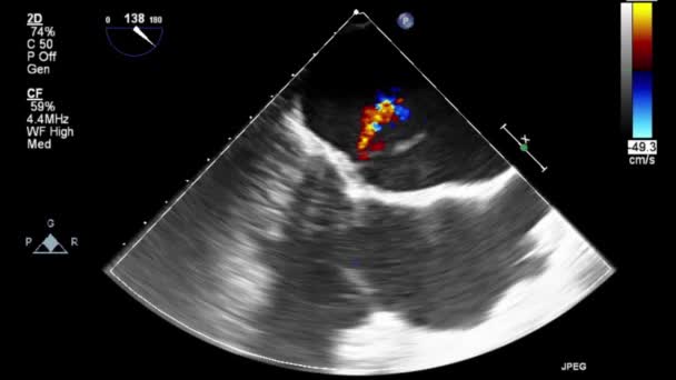 Vídeo Ultra Sonográfico Transesofágico Modo Doppler — Vídeo de Stock