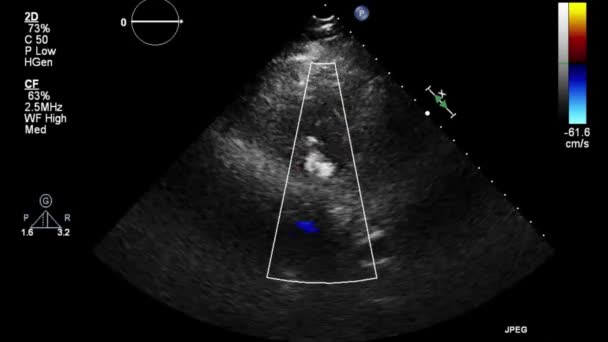 Transesophageal Ultrasound Video Doppler Mode — Stok video