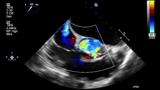 Vídeo Ultra Sonográfico Transesofágico Modo Doppler — Vídeo de Stock